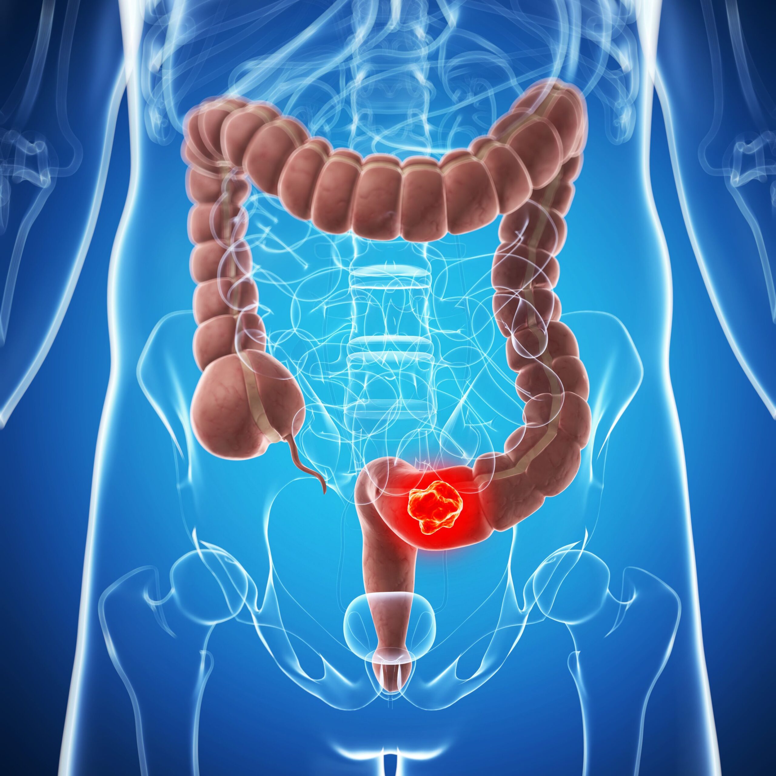 A Distinct Subtype of Fusobacterium Nucleatum Identified as Key Player in Colorectal Cancer